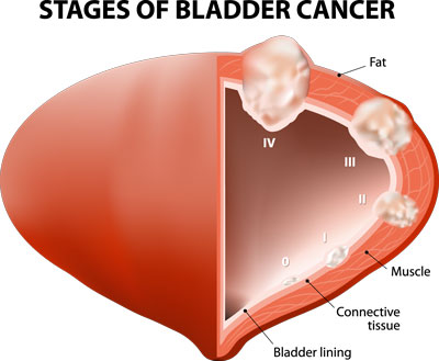 Actos Bladder Cancer Research
